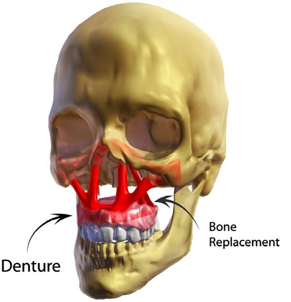 Click to enlarge Facial Reconstruction_3