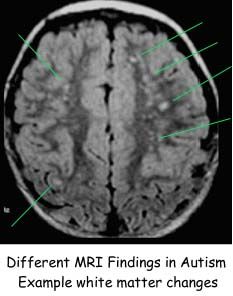 mri austic brain