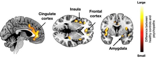 Brain basis for psychopathy
