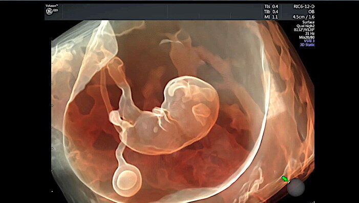 fetal ultrasound