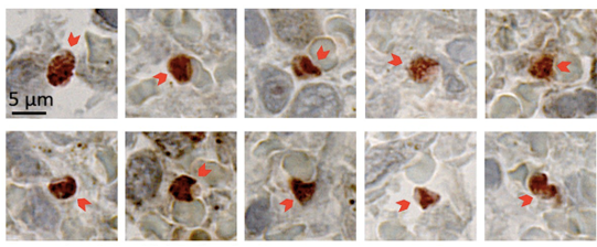 spleen malaria
