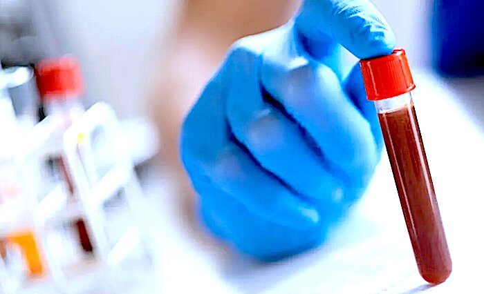 Blood sample