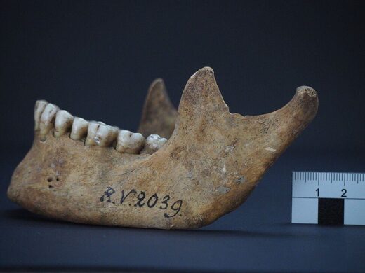 Click to enlarge jawbone plague