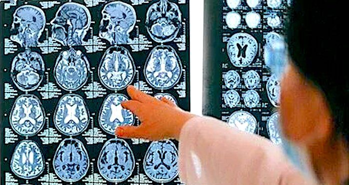brain anomalies