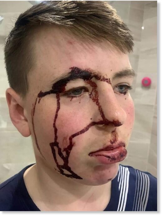 14-year-old victim of Police Brutality from Finglas, Dublin