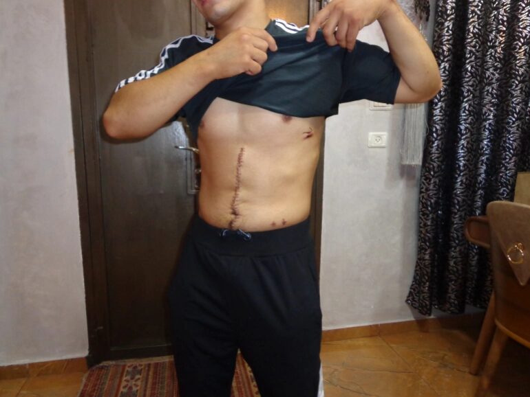 Click to enlarge Harby Rajabe extensive surgery after shot by Israeli police.