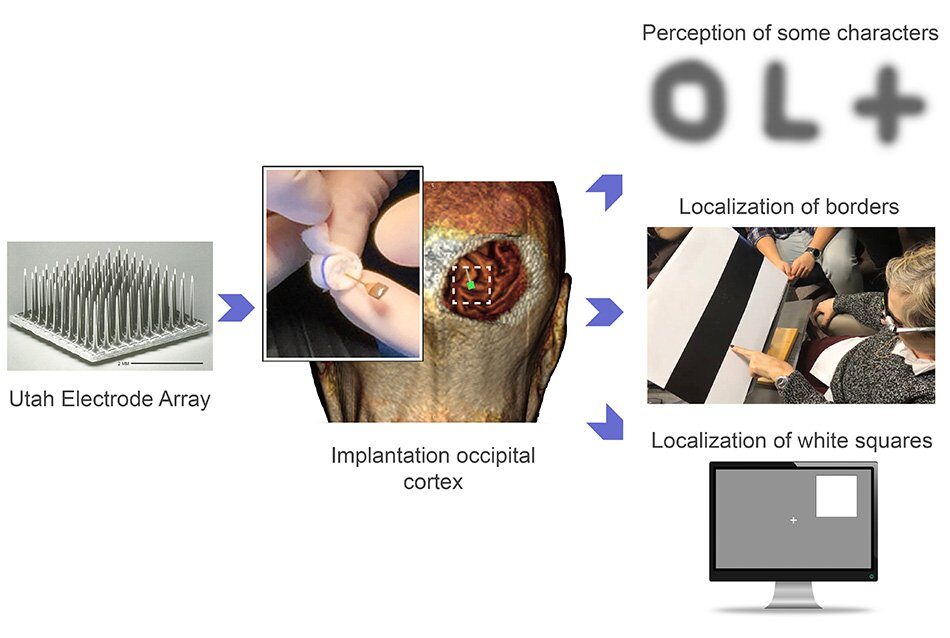 Click to enlarge brain implant visual stimulation blind