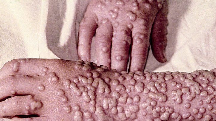 smallpox