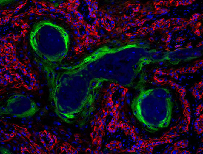 Click to enlarge squamous cell carcinoma cancer mouse model