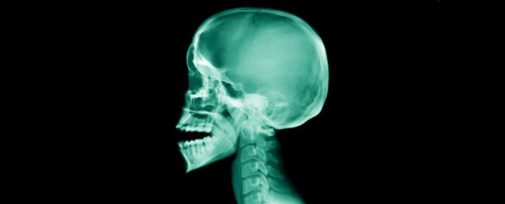 xray skull