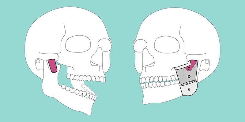 Click to enlarge jaw muscle