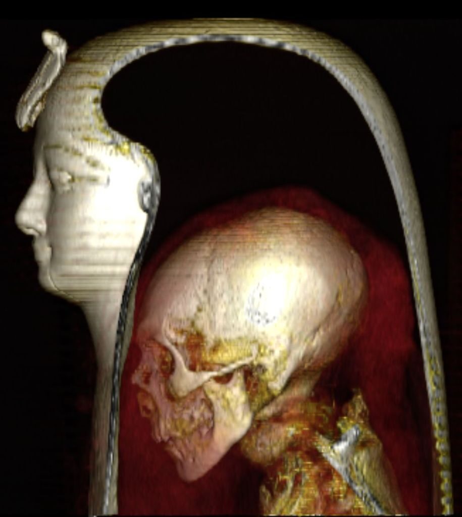 Click to enlarge CT scan of the skull and neck.