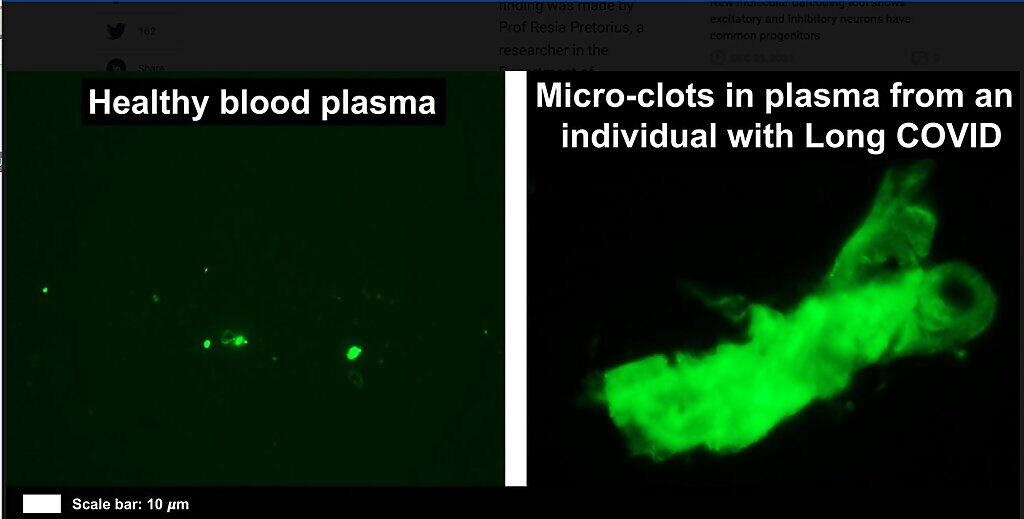 long covid microclots