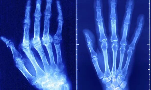 Click to enlarge Rheumatoid arthritis