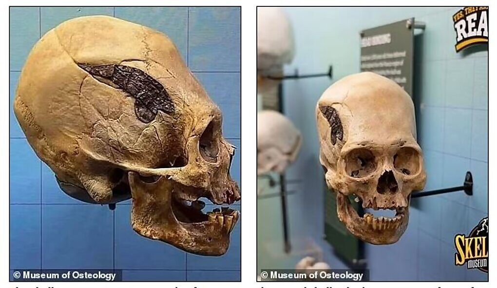 Click to enlarge elongated skull surgery