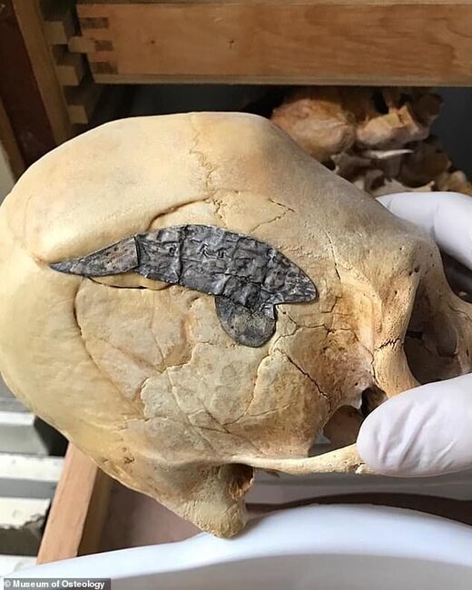 Metal plate inserted into 2,000 year-old Peruvian warrior's skull may be oldest evidence of surgery