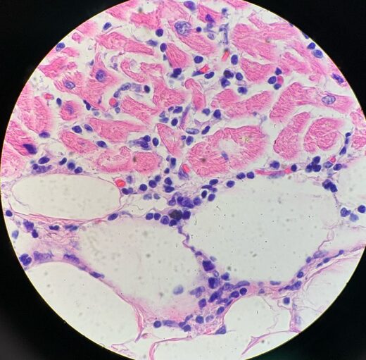Click to enlarge Small area of myocarditis/pericarditis under the microscope