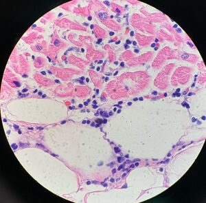 Small area of myocarditis/pericarditis under the microscope