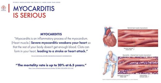 Myocarditis illustration