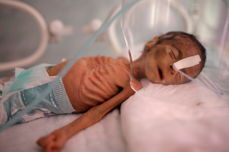 yemen baby starvation