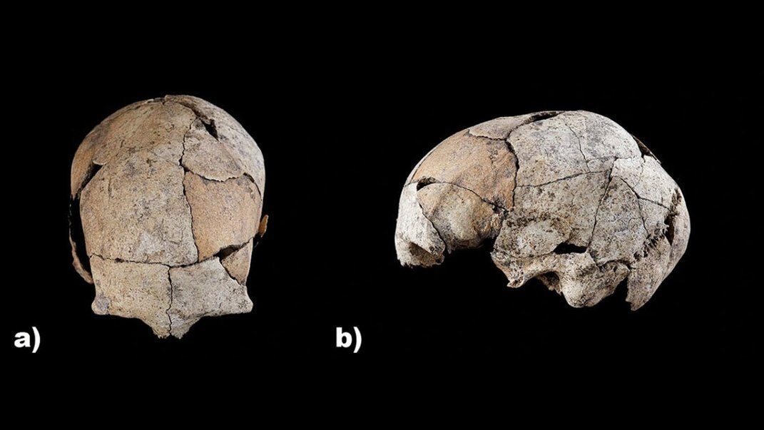 Click to enlarge ancient skull ear surgery