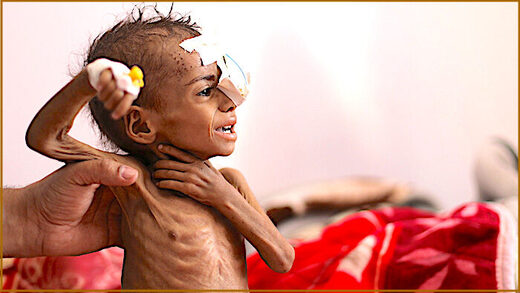 Click to enlarge Child malnourished