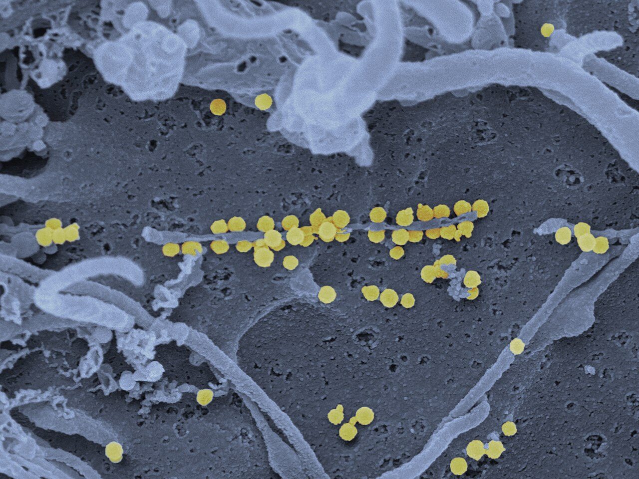 Crimean-Congo haemorrhagic fever