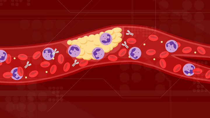 blood clot