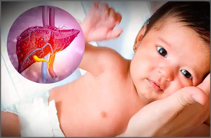 Hepatitis child