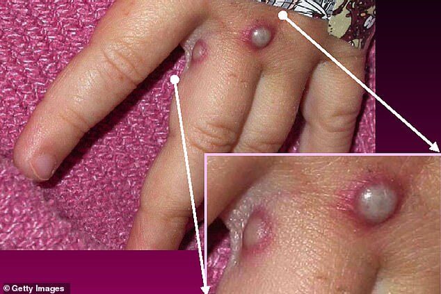 Click to enlarge Monkeypox