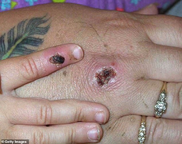 Click to enlarge Monkeypox