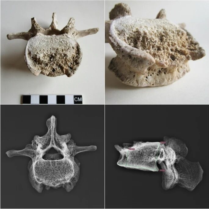 Click to enlarge Fourth Lumbar