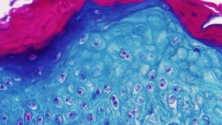 Magnified image of skin tissue infected with monkeypox virus