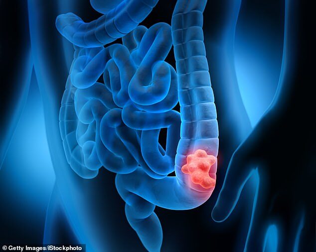 colorectal cancer