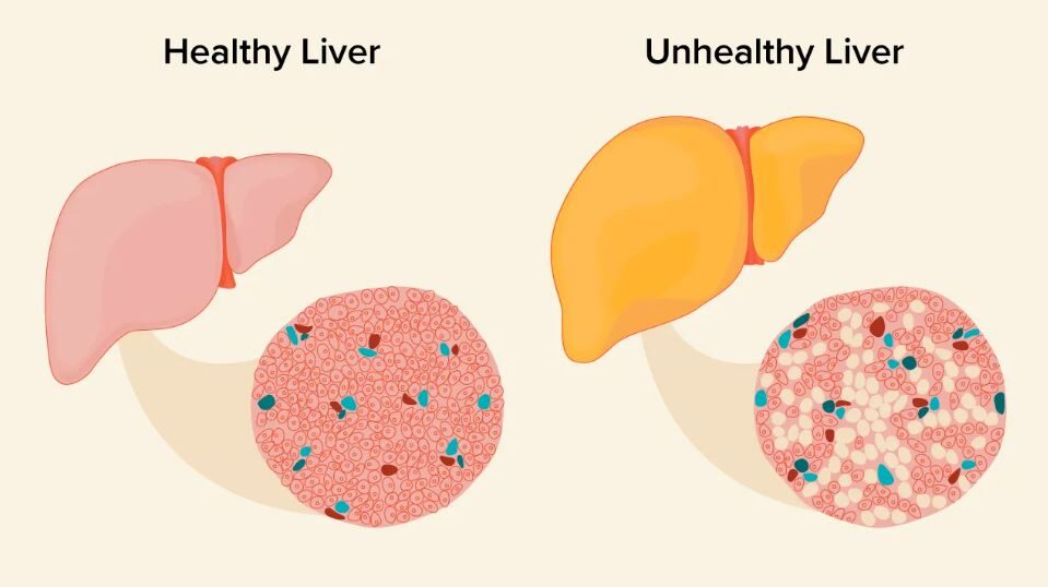 fatty liver