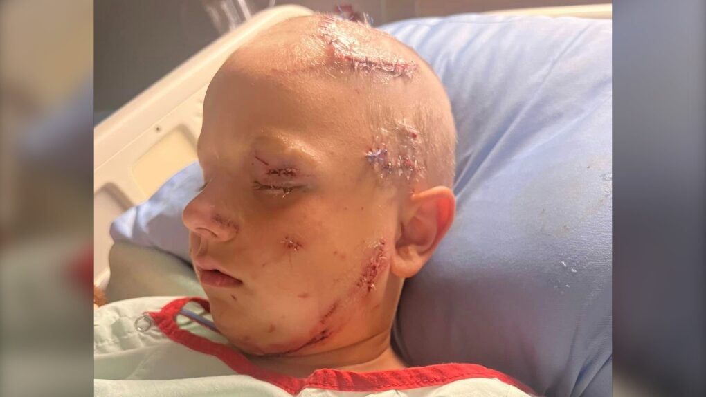 Click to enlarge Cason, 7, was attacked by a cougar while camping near Rocky Mountain House on July 31, 2022.