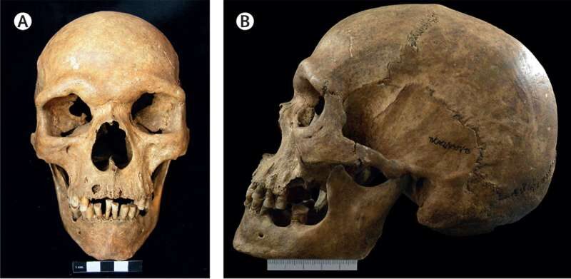 skull