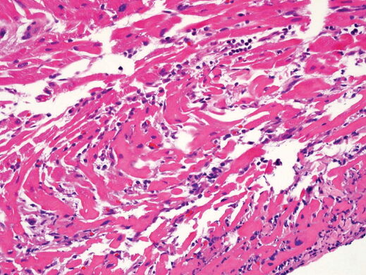 myocarditis