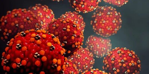 Measles