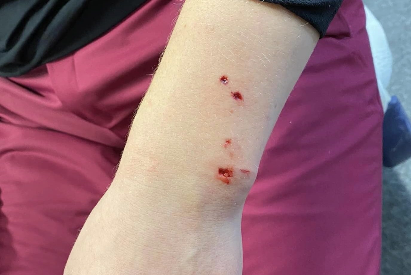 Click to enlarge The bite wound on the arm of the female skier, identified only as ‘Sofia’ on social media