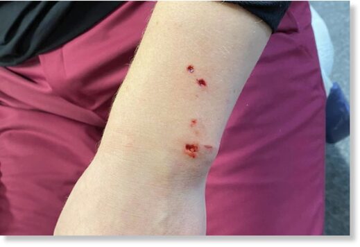 Click to enlarge The bite wound on the arm of the female skier, identified only as βSofiaβ on social media