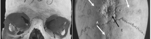 medieval skull cranial surgery