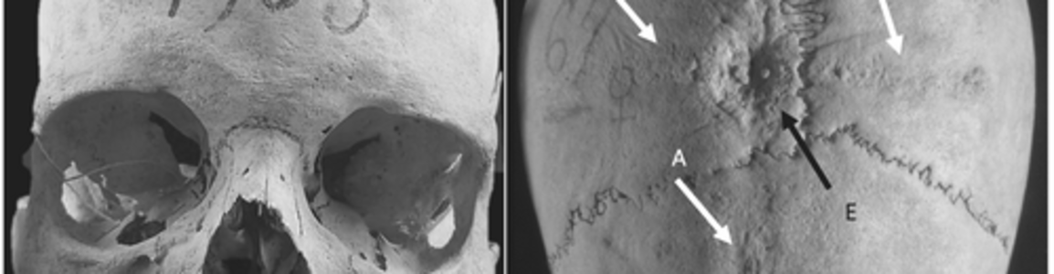 medieval skull cranial surgery