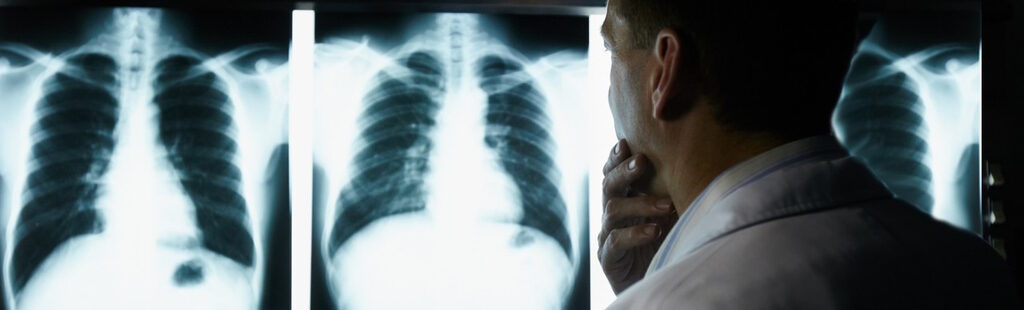 x-rays tuberculosis