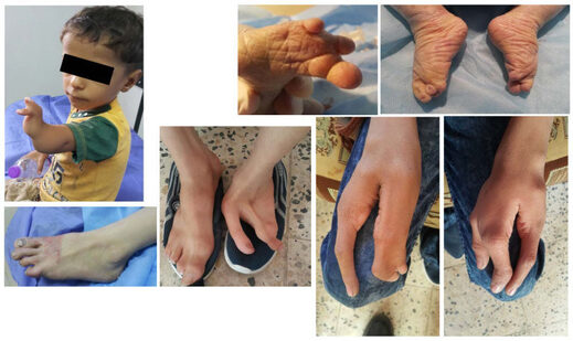 fallujah depeleted uranium birth defects