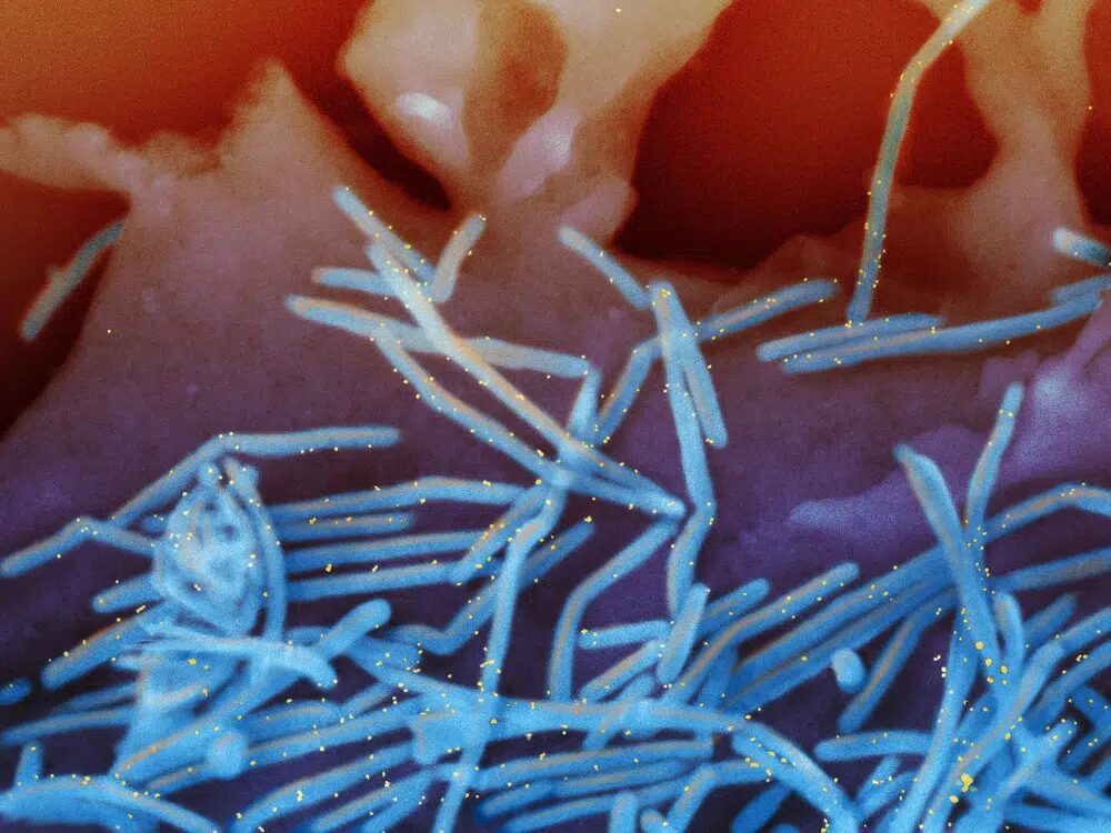 respiratory syncytial virus (RSV)