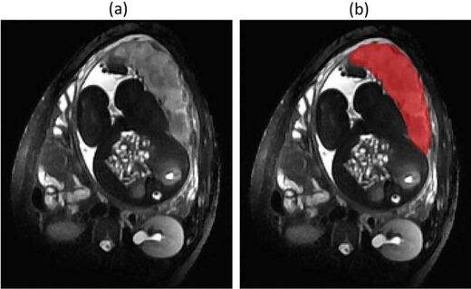 Click to enlarge placenta lockdown covid