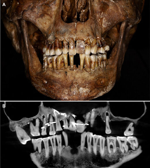 Click to enlarge teeth aristocrat