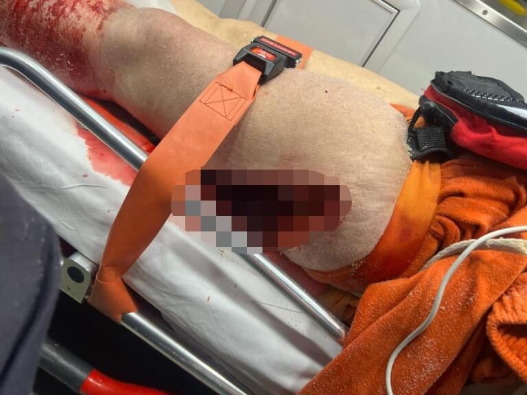 The woman sustained a gash on her leg just before 6 p.m. on Monday.