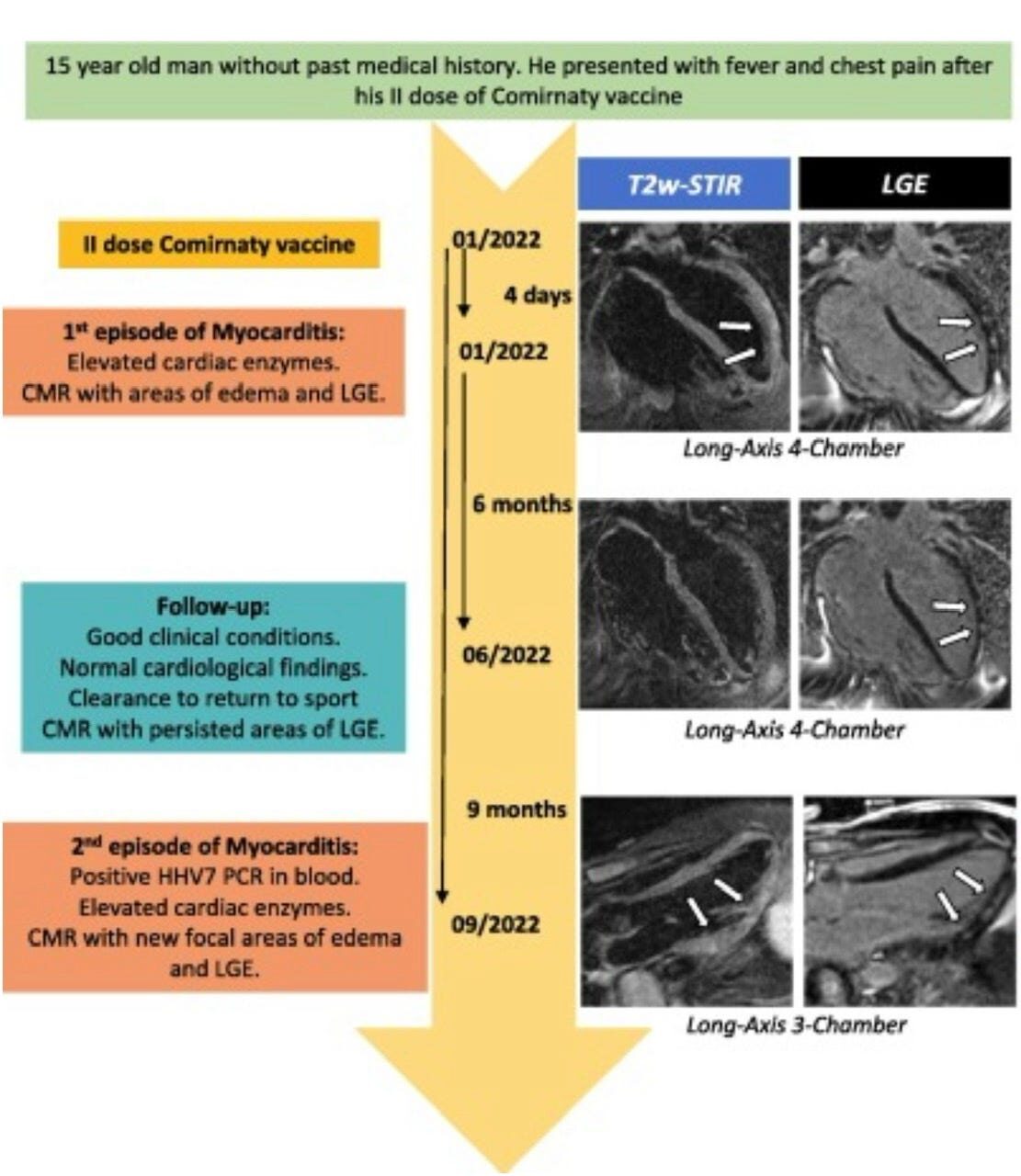 myocarditis